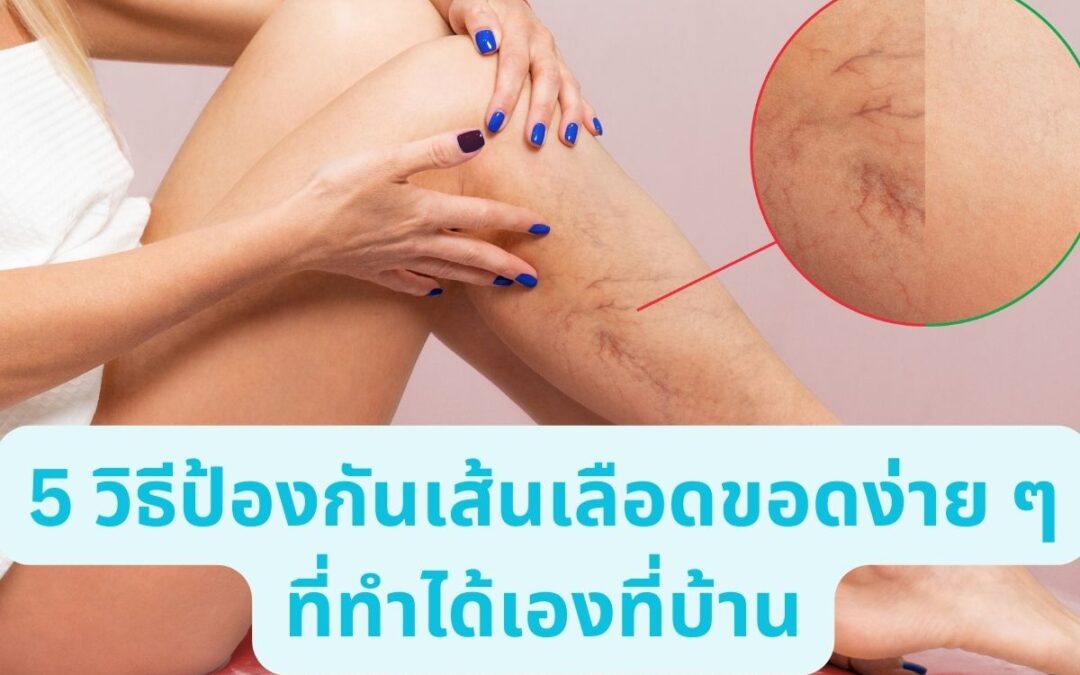 5 วิธีป้องกันเส้นเลือดขอดง่าย ๆ ที่ทำได้เองที่บ้าน