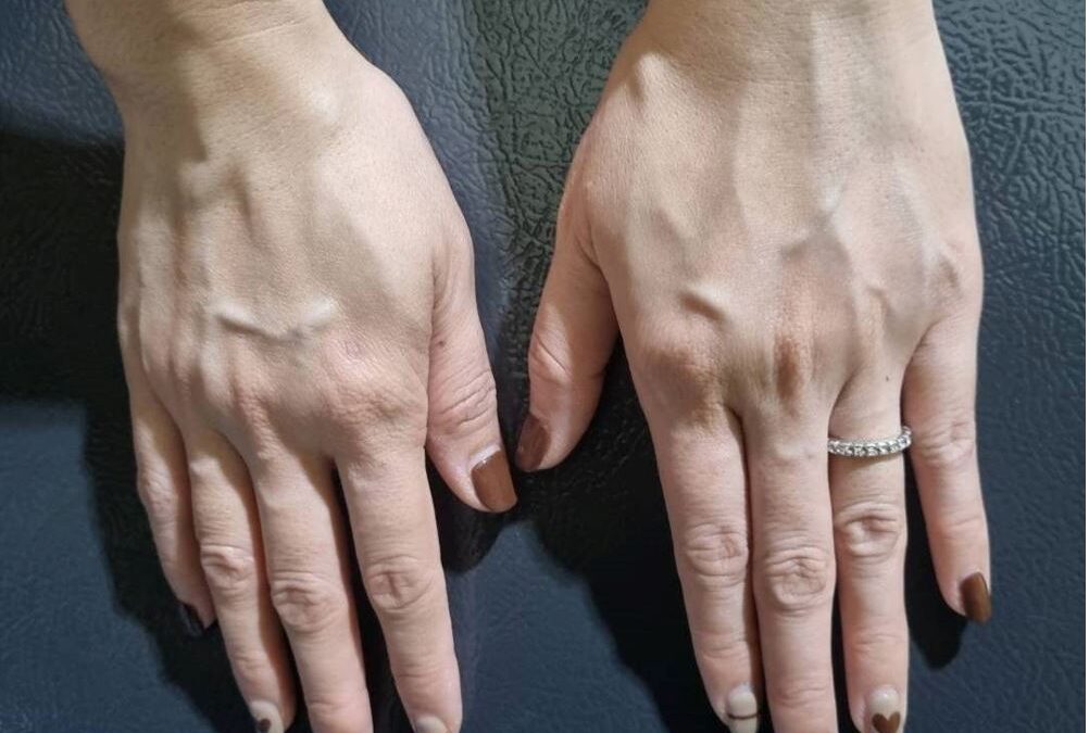 การฉีดยารักษาเส้นเลือดปูดที่มือ ปลอดภัยจริงหรือไม่?