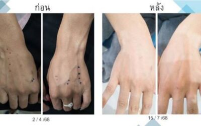 ฉีดยาเส้นเลือดปูดที่มือแล้ว เส้นเลือดจะกลับมาอีกไหม?