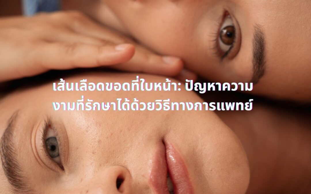 เส้นเลือดขอดที่ใบหน้า: ปัญหาความงามที่รักษาได้ด้วยวิธีทางการแพทย์