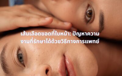 เส้นเลือดขอดที่ใบหน้า: ปัญหาความงามที่รักษาได้ด้วยวิธีทางการแพทย์