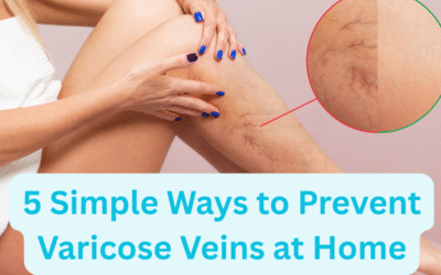 5 Simple Ways to Prevent Varicose Veins at Home