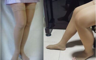 เส้นเลือดขอด: เมื่อใส่ถุงน่องแล้วขาไม่ยุบ อาจถึงเวลาหาสาเหตุที่แท้จริง