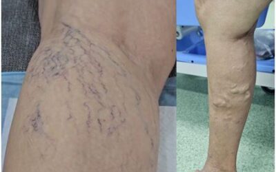 หลังการรักษาเส้นเลือดขอดและเส้นเลือดฝอย: หายขาดจริงหรืออาจกลับมาเป็นอีก?