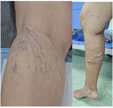 หลังการรักษาเส้นเลือดขอดและเส้นเลือดฝอย: หายขาดจริงหรืออาจกลับมาเป็นอีก?