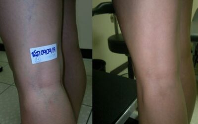 เส้นเลือดฝอยที่เห็น จะกลายเป็นเส้นเลือดขอดหรือไม่ เราควรทำอย่างไรเมื่อเห็นเส้นเลือดฝอยขึ้นที่ขา