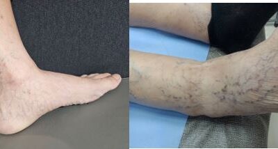Ankle Spider Veins: A Common but Often Overlooked Problem — And How to Treat Them Effectively