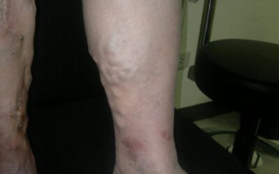 Varicose Veins: More Dangerous Than You Think — Not Just a Cosmetic Issue