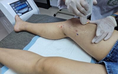 Are Visible Spider Veins Going to Become Varicose Veins? What You Should Do When You Notice Spider Veins on Your Legs