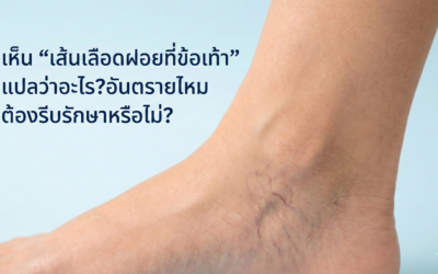 เห็น “เส้นเลือดฝอยที่ข้อเท้า” แปลว่าอะไร? อันตรายไหม ต้องรีบรักษาหรือไม่?