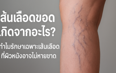 เส้นเลือดขอดเกิดจากอะไร? ทำไมรักษาเฉพาะเส้นเลือดที่ผิวหนังอาจไม่หายขาด