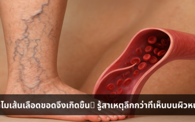 ทำไมเส้นเลือดขอดจึงเกิดขึ้น? รู้สาเหตุลึกกว่าที่เห็นบนผิวหนัง
