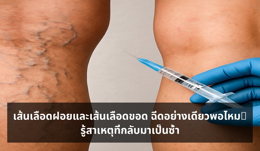 เส้นเลือดฝอยและเส้นเลือดขอด ฉีดอย่างเดียวพอไหม? รู้สาเหตุที่กลับมาเป็นซ้ำ