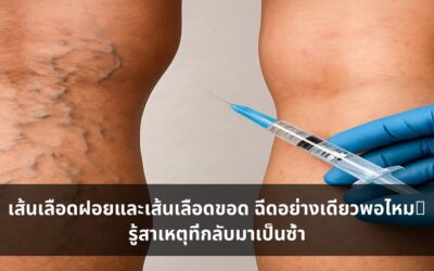 เส้นเลือดฝอยและเส้นเลือดขอด ฉีดอย่างเดียวพอไหม? รู้สาเหตุที่กลับมาเป็นซ้ำ