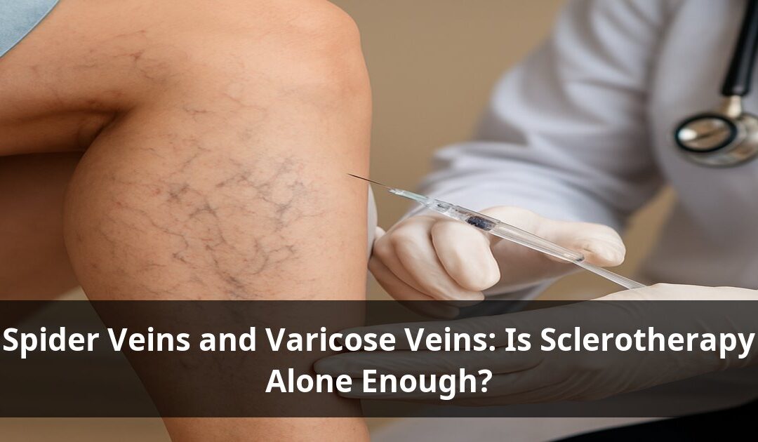 Spider Veins and Varicose Veins: Is Sclerotherapy Alone Enough?
